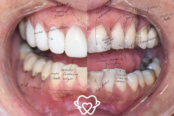 What cosmetic dental procedure is right for me